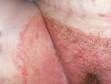 This image displays the sharp, accentuated edge of the skin affected with tinea cruris.