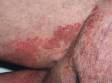 Tinea (ringworm or jock itch) will often affect the moist area of the groin and upper thighs, as displayed in this image.
