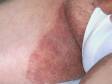 This image displays the fungal infection typical of tinea cruris ("jock itch").