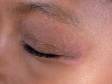This image displays the outside of an eye area with a circular, scaling, pink patch due to tinea (ringworm).