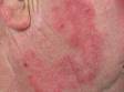 As displayed in this image, large patches of tinea (ringworm) will often have a central area of clear skin.
