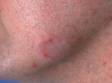 This image displays an early area of tinea on the jaw with a C-shaped, swollen red area that is slightly scaly.