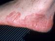 This image displays the red and inflamed skin with a scaly edge typical of tinea pedis (athlete's foot).
