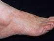 This image displays extensive athlete's foot of the top, side, and sole of the foot.