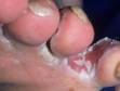 Moisture has been a prime factor encouraging athlete's foot infection between the toes displayed in this image.