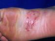 Tinea pedis (athlete's foot) can cause blisters, as displayed in this scaly, red patch.