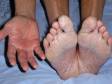 This image displays two feet-one hand syndrome that is typical in tinea pedis (athlete's foot), with both feet and only one hand being affected.