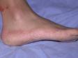 Tinea pedis (athlete's foot) often causes a "moccasin foot" with dry, red, rough areas along the entire side of the foot.