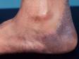 As displayed in this image, tinea pedis (athlete's foot) often has a sharp border.
