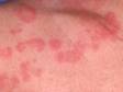 This image displays round, pink areas with clear zones common to urticaria (hives).