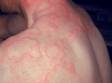 This image displays urticaria (hives).