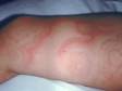 This image displays a severe case of urticaria (hives).