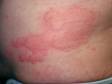 This image displays welts and large hair follicle openings caused by swelling from urticaria (hives).