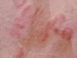 Urticaria (hives) often forms rings, and ring-like shapes.