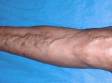 This image displays dilated varicose veins typical of varicosities.