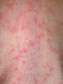 In viral exanthem the pink patch of affected skin should turn white when you push on it with a finger.