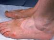 This image displays vitiligo on the backs of feet.