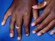 Vitiligo is an auto-immune condition that results in flat areas of pigment loss. Fingers are a common location.