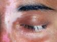 The loss of pigment from hairs in the eyelash area accentuates the color loss of vitiligo.