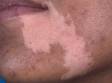 In people with darker skin, the areas of pigment loss in vitiligo are quite distinct.