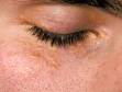 This image displays yellow-white elevations of the skin in a patient with early xanthelasma palpebrum.