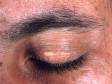 Slightly elevated lesions of xanthelasma can occur on the middle of the eyelids.