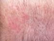 This image displays a mild rash due to itching caused by dry skin.