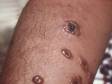 In cutaneous anthrax, skin lesions quickly turn into blisters (vesicles) then form black scabs (eschars). These anthrax lesions show the transition from blisters to eschars.