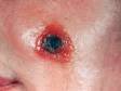 In cutaneous anthrax, a blister (vesicle or bulla) is the first skin lesion. This transient fluid-filled lesion quickly breaks, and then a black scab (eschar) develops at the center within days.