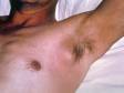 A large, swollen, red lymph node (bubo) in the armpit (axillary) of a person with bubonic plague. Symptoms of the plague are severe and include a general weak and achy feeling, headache, shaking chills, fever, and pain and swelling in affected regional lymph nodes (buboes).