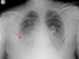 Chest x-ray showing bilateral lower lobe infiltrates consistent with diagnosis of Legionnaire's disease.