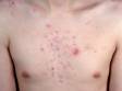 This image displays cysts and deep inflammatory lesions on the chest caused by acne.