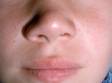 This child has several whiteheads (closed comedones) on the cheeks.