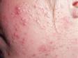 This child has moderately severe acne with whiteheads (closed comedones), bumps, and pus-filled lesions.