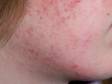 This image displays a child with acne that is starting to improve with treatment.