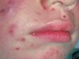 This image displays a three-year-old child with large cysts and multiple acne bumps on the nose and chin.