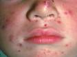 This image displays a three-year-old child with whiteheads (closed comedones) on the chin, a cyst on the nose tip, and multiple pus-filled lesions around the nose.