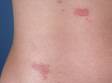 Insect bites or bug bites can cause localized redness and itching.