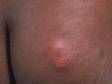 On people with darker skin, inflammation and redness from insect bites can appear as red-brown-colored lesions.