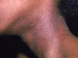 This image displays atopic dermatitis involving the cheeks and neck.