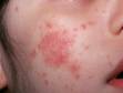 Red or pink, scaling lesions and dry-appearing skin are typical in atopic dermatitis (eczema).