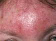 Cellulitis often causes warmth, redness, pain or tenderness, and skin swelling.