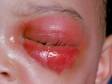 Orbital cellulitis quickly develops with redness, pain, and marked swelling around the eye.
