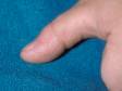 This image displays the area of a healed wart.