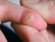 This image displays the "black dots" typical of warts, which are clotted, fine blood vessels in the skin.