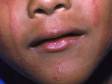 This image displays the linear areas of redness and scaling typical to a contact allergy.