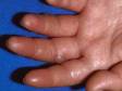 This image displays fluid-filled blisters from an intense allergic reaction to a topical ointment.
