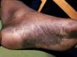 This image displays the scaling and cracked areas of the soles of the feet typical of prolonged dyshidrotic eczema.