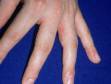This image displays a typical case of dyshidrotic dermatitis on the fingers.