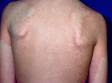 This image displays the widespread red bumps and slightly elevated lesions seen in erythema infectiosum (fifth disease).